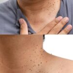 محلول برداشتن خال و زگیل و میخچه (در یک جلسه)