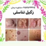 برداشتن زگیل تناسلی با محلول در یک جلسه