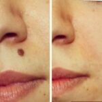 محلول رفع خال و زگیل و میخچه و زائده های پوستی