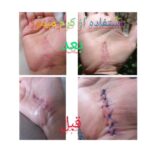 کرم ترمیم کننده میموزا